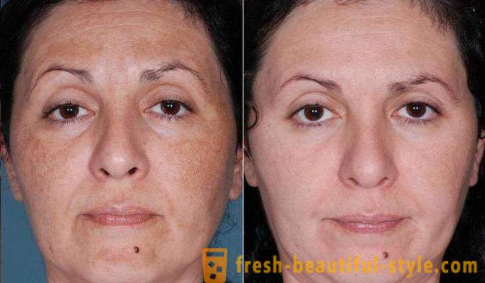 Acid schillen voor het gezicht: reviews, foto's voor en na