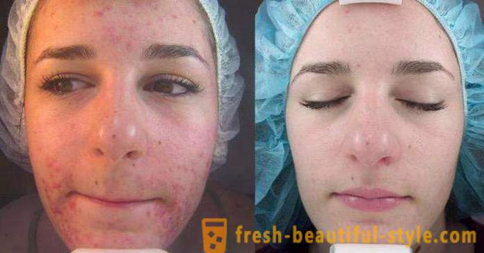 Acid schillen voor het gezicht: reviews, foto's voor en na