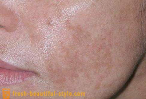 Bruine vlekken op het gezicht: de oorzaken van en behandelingen. bruine vlekken