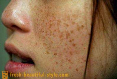 Bruine vlekken op het gezicht: de oorzaken van en behandelingen. bruine vlekken