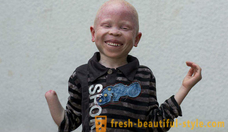 De tragische geschiedenis van de Tanzaniaanse albino's