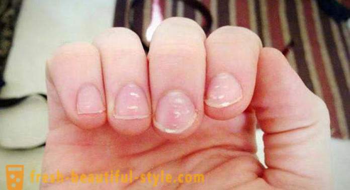 Witte vlekken op de nagels van de vingers: de oorzaken en behandeling