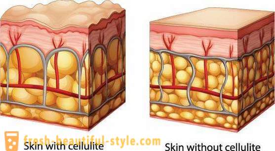 Hoe maak je een cellulitis crème te kiezen: recensies van klanten en advies schoonheidsspecialisten