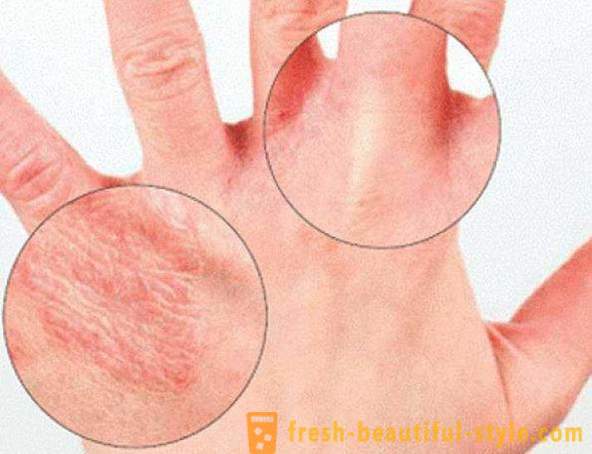 Droge huid van de handen: Veroorzaakt. Zeer droge huid, wat te doen?