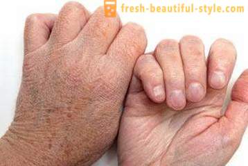 Droge huid van de handen: Veroorzaakt. Zeer droge huid, wat te doen?