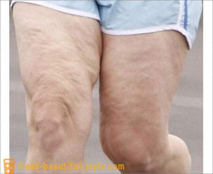 Hoe zich te ontdoen van cellulitis op de benen? Oefeningen voor de benen van cellulitis