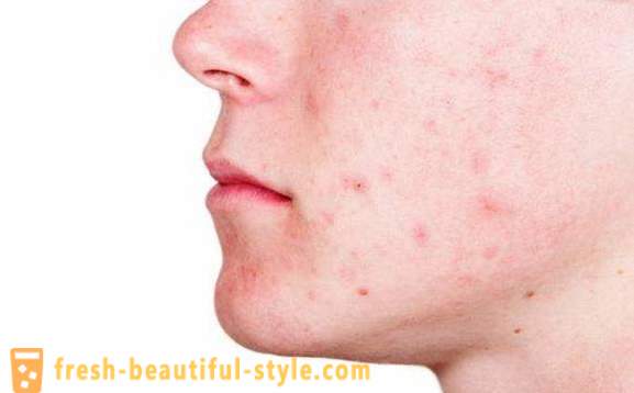 Het wegwerken van acne en sporen van hen. Hoe zich te ontdoen van acne op verschillende gebieden van de huid