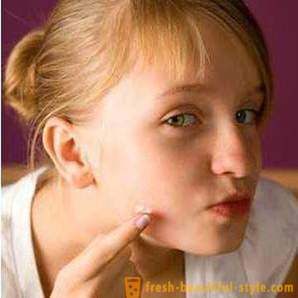 Hoe zich te ontdoen van littekens na acne. De belangrijkste manieren