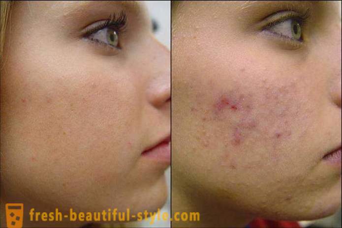 Hoe kunt u uw gezicht van acne te reinigen, zodat ze niet meer terug